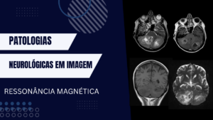 Patologias Neurológicas em Imagem